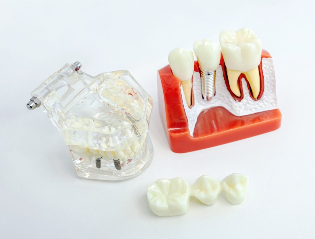 Dental implant and dentures demonstration models side by side