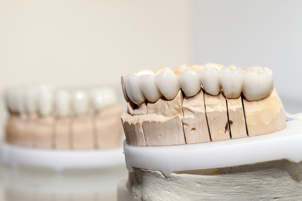 Close-up of zirconia porcelain dental crowns on a model mold